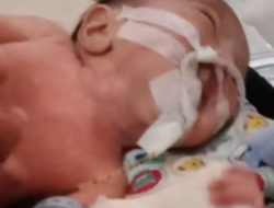 Kasus Bayi Terlahir Tanpa Dinding Perut di Polman, Usus Terburai